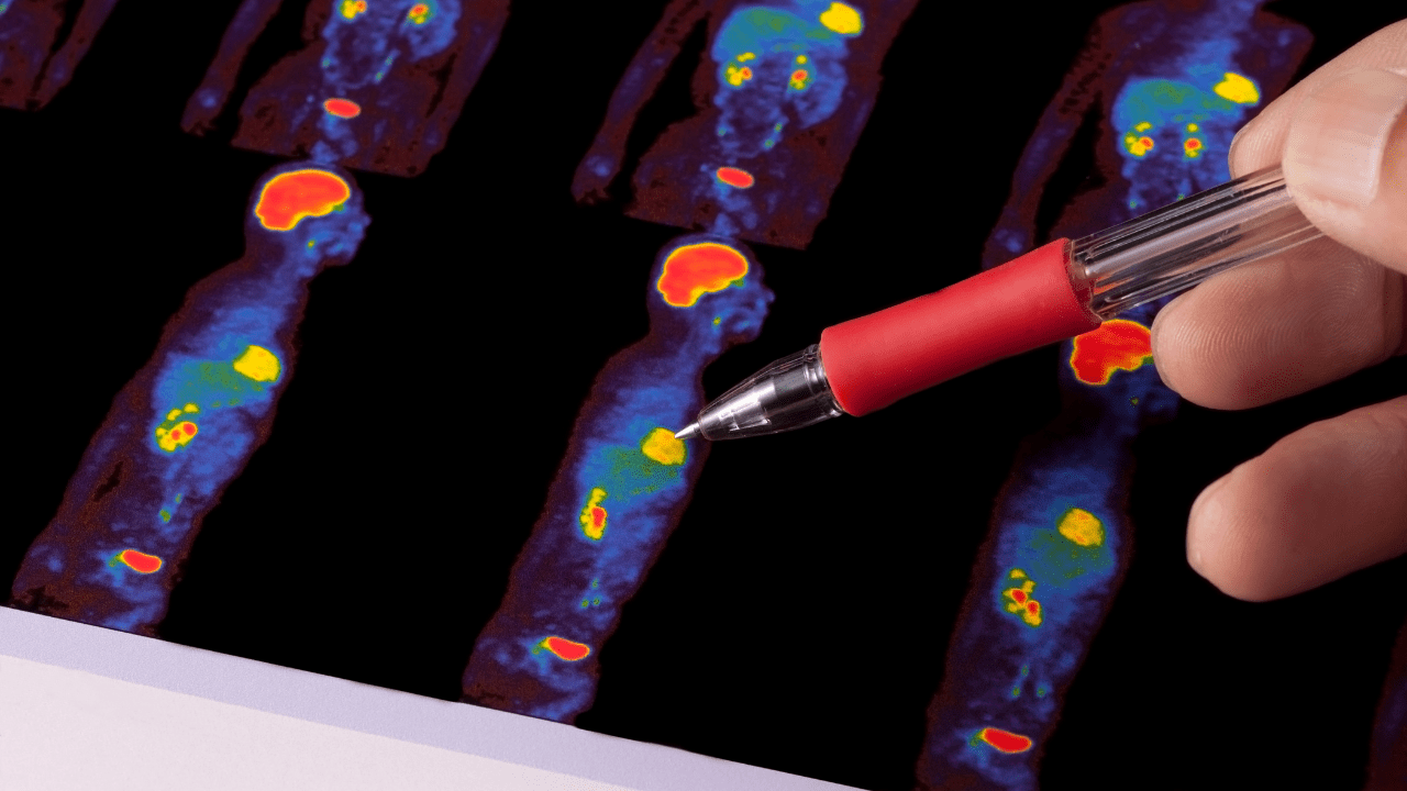 Why and how to standardize quantified PET scans in your trial TRACER