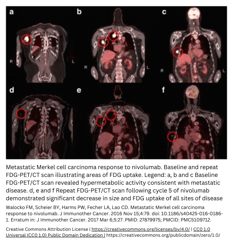 Metastatic Merkel cell carcinoma nivolumab