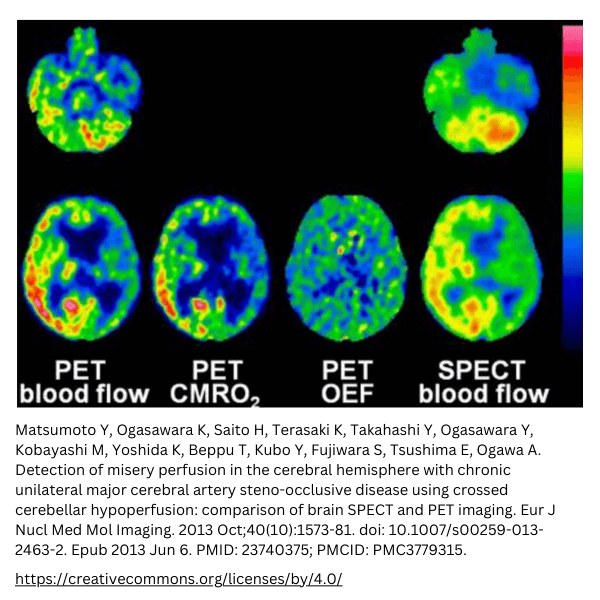 PET vs SPECT resolution