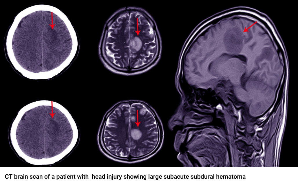 ct scan