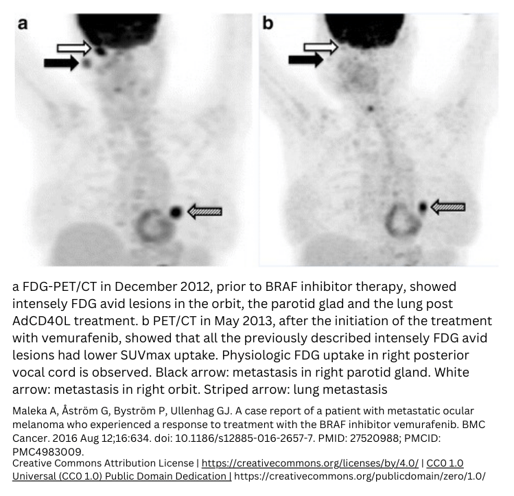 metastatic ocular melanoma BRAF inhibitor vemurafenib