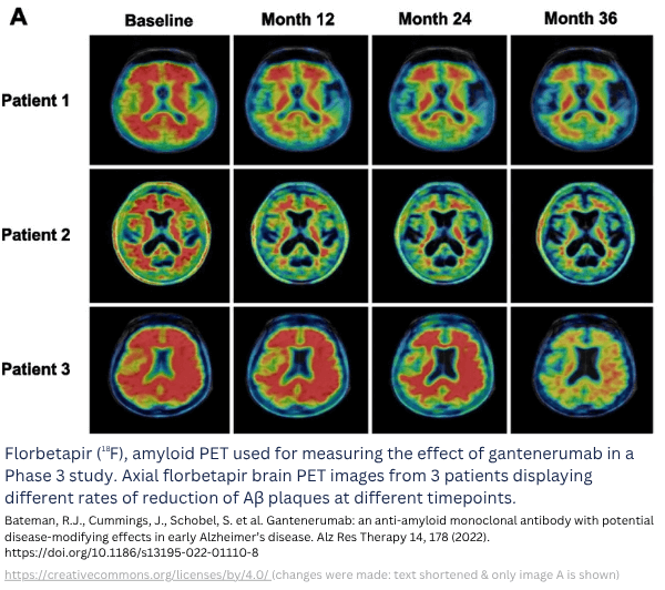 Aβ plaque reduction with gantenerumab in basal ganglia